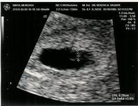 1stsonogram