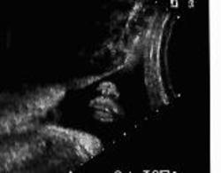 32weeksonogram